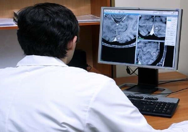  الجلطة الدماغية الدقيقة مؤشر خطير لا يجب تجاهله ... فماهي أعراضها الخفية؟